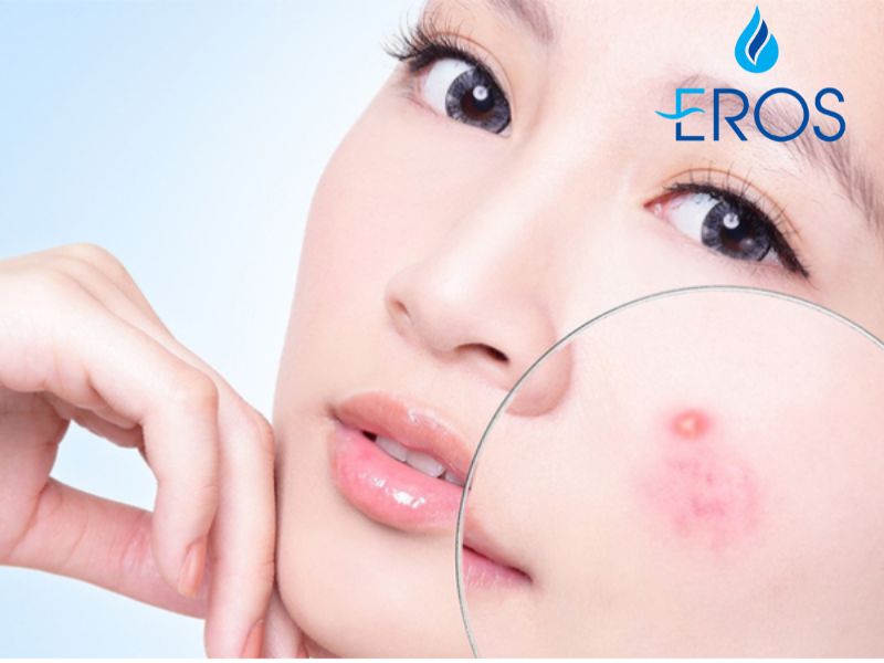 Công dụng của hyaluronic acid đối với làn da