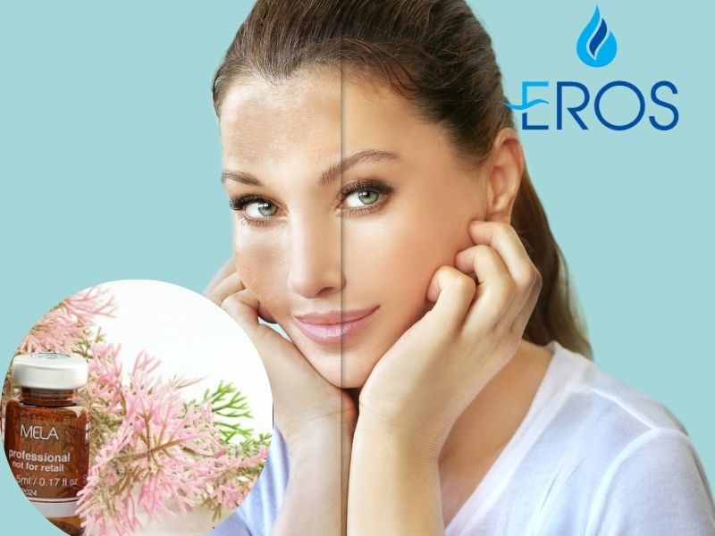 Tiêm meso trị nám, tàn nhang