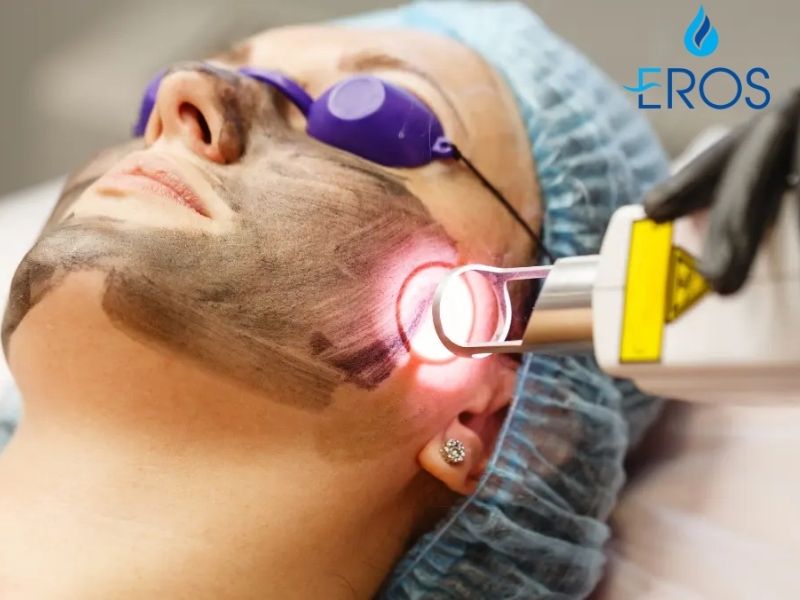 Revlite là công nghệ trị nám bằng laser cùng hiệu quả làm mịn da
