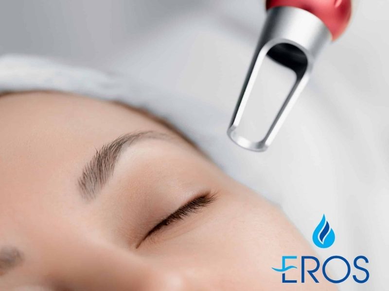 Pico là công nghệ laser trị nám khác phổ biến