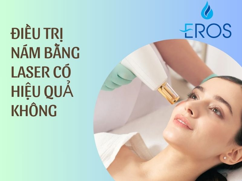 điều trị nám bằng laser