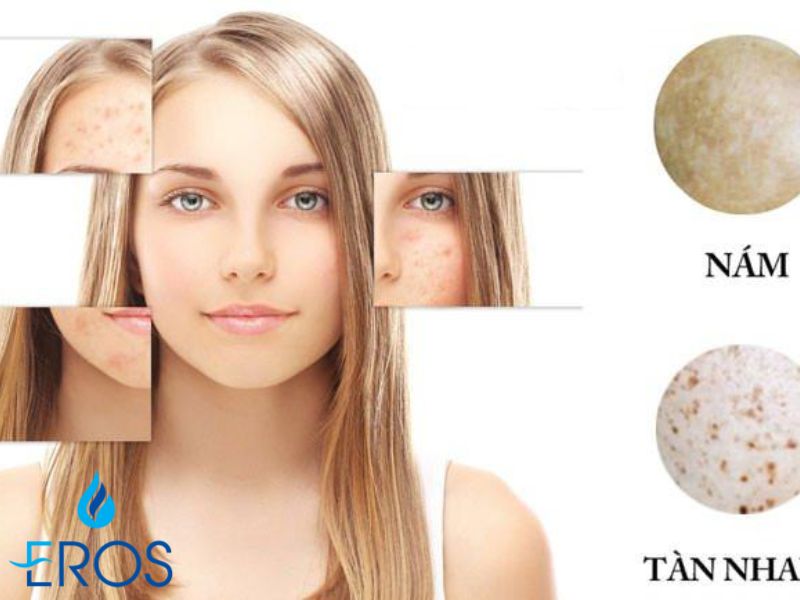 Nám và tàn nhang luôn là nỗi ám ảnh của phái đẹp