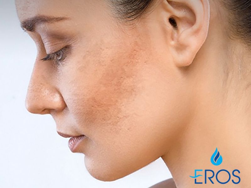 Nám là các đốm nâu, sạm tạo nên những vùng da không đều màu