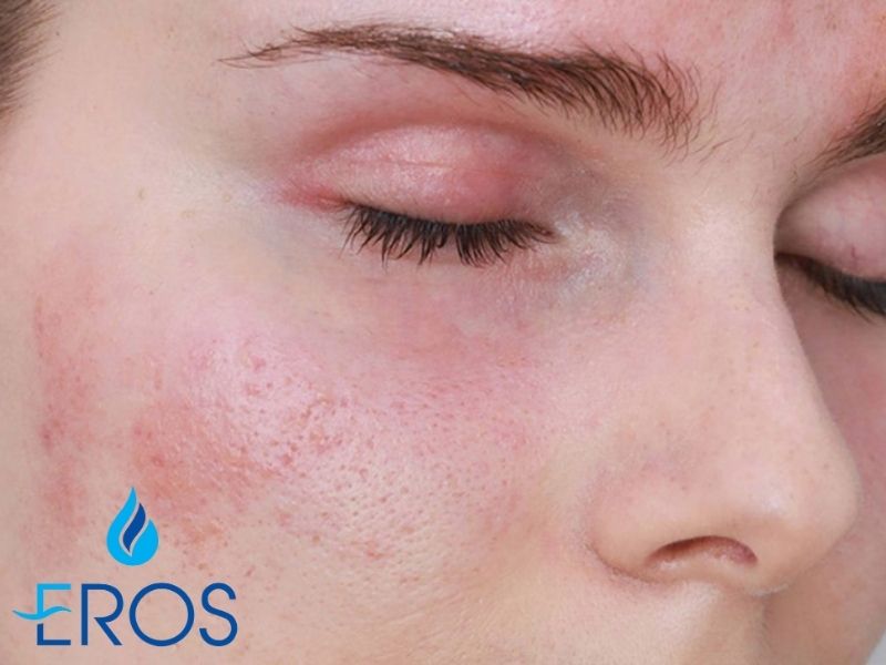 Cần lựa chọn đơn vị có uy tín để đảm bảo an toàn khi trị nám bằng laser